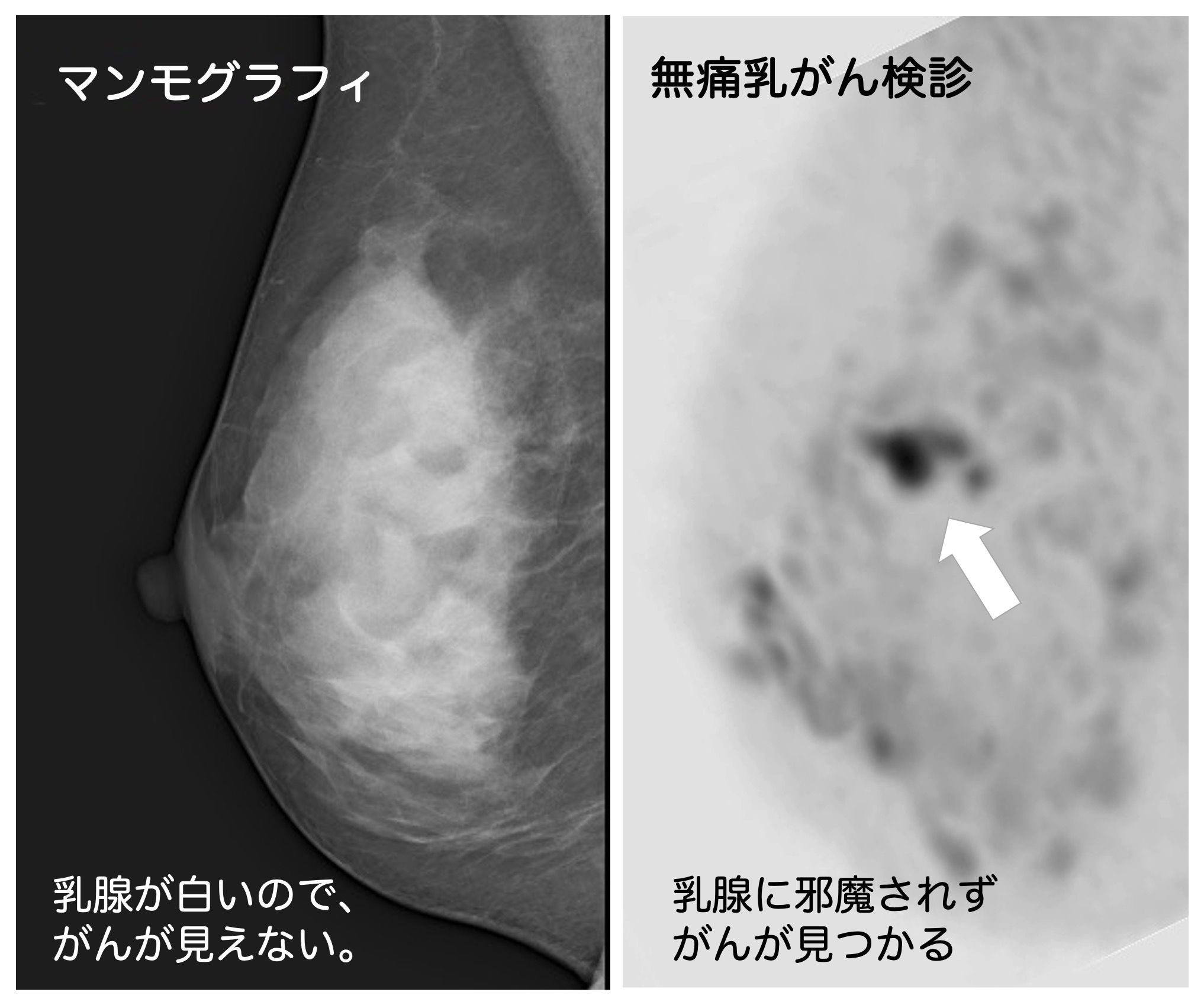 胸を圧し潰す 乳がん検査は痛すぎる 服も着たまま出来る ドゥイブス法 を知っていますか ニコニコニュース